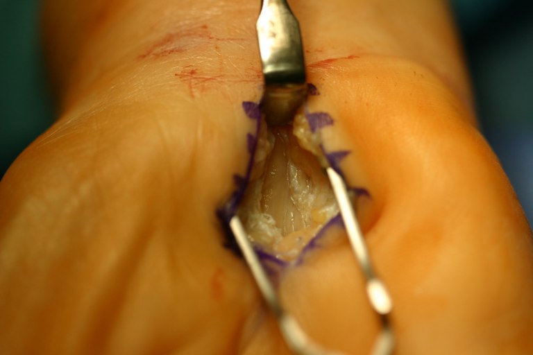 Decompressed carpal tunnel. Median nerve at base, flexor retinaculum split to either side https://www.flickr.com/photos/handarmdoc
